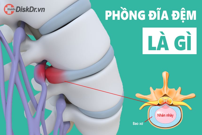 Phồng đĩa đệm là gì