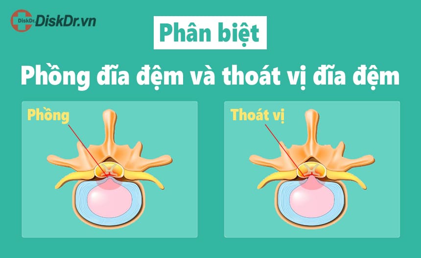 Phồng đĩa đệm và thoát vị đĩa đệm