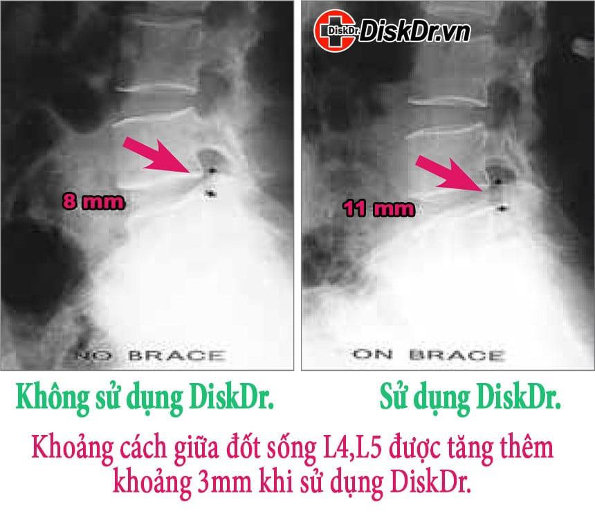 DiskDr giúp gia tăng khoảng cách đốt sống L4 L5 thêm 3mm