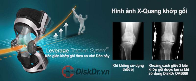 Nguyên lý kéo giãn khớp gối DiskDr OA5000