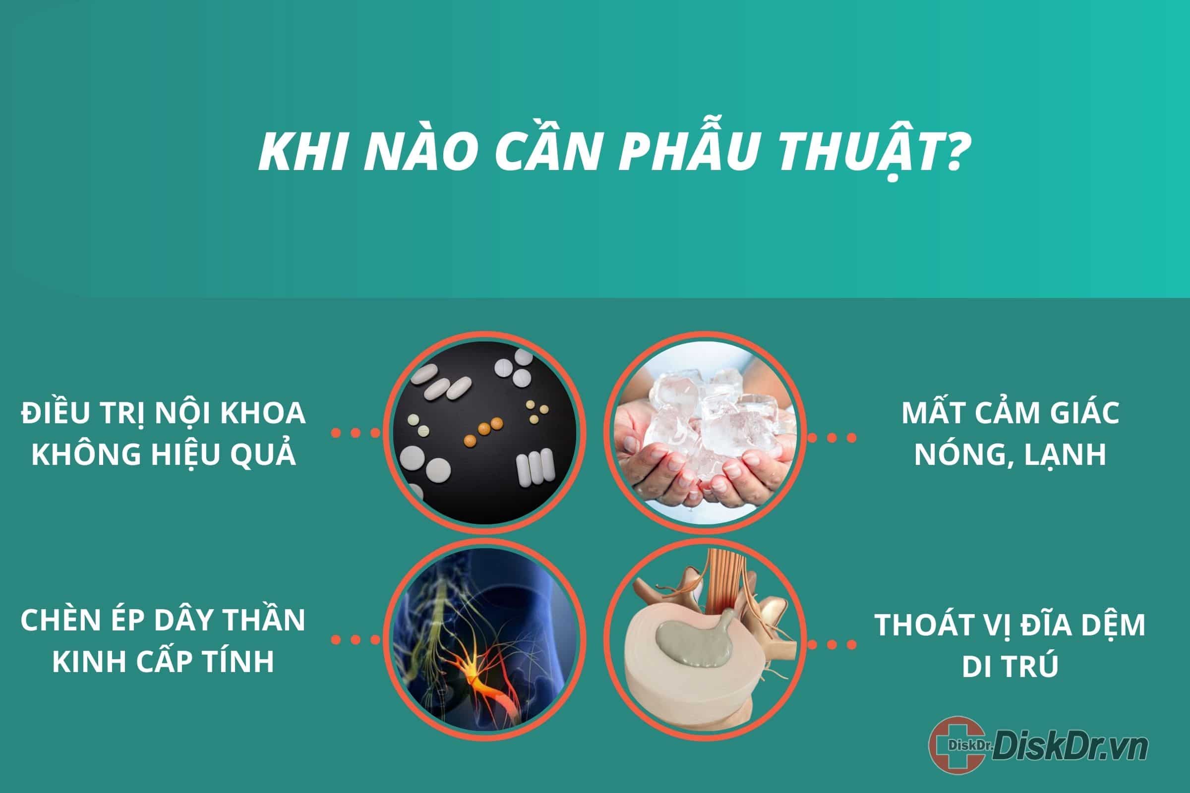 Khi nào cần mổ thoát vị đĩa đệm cột sống lưng