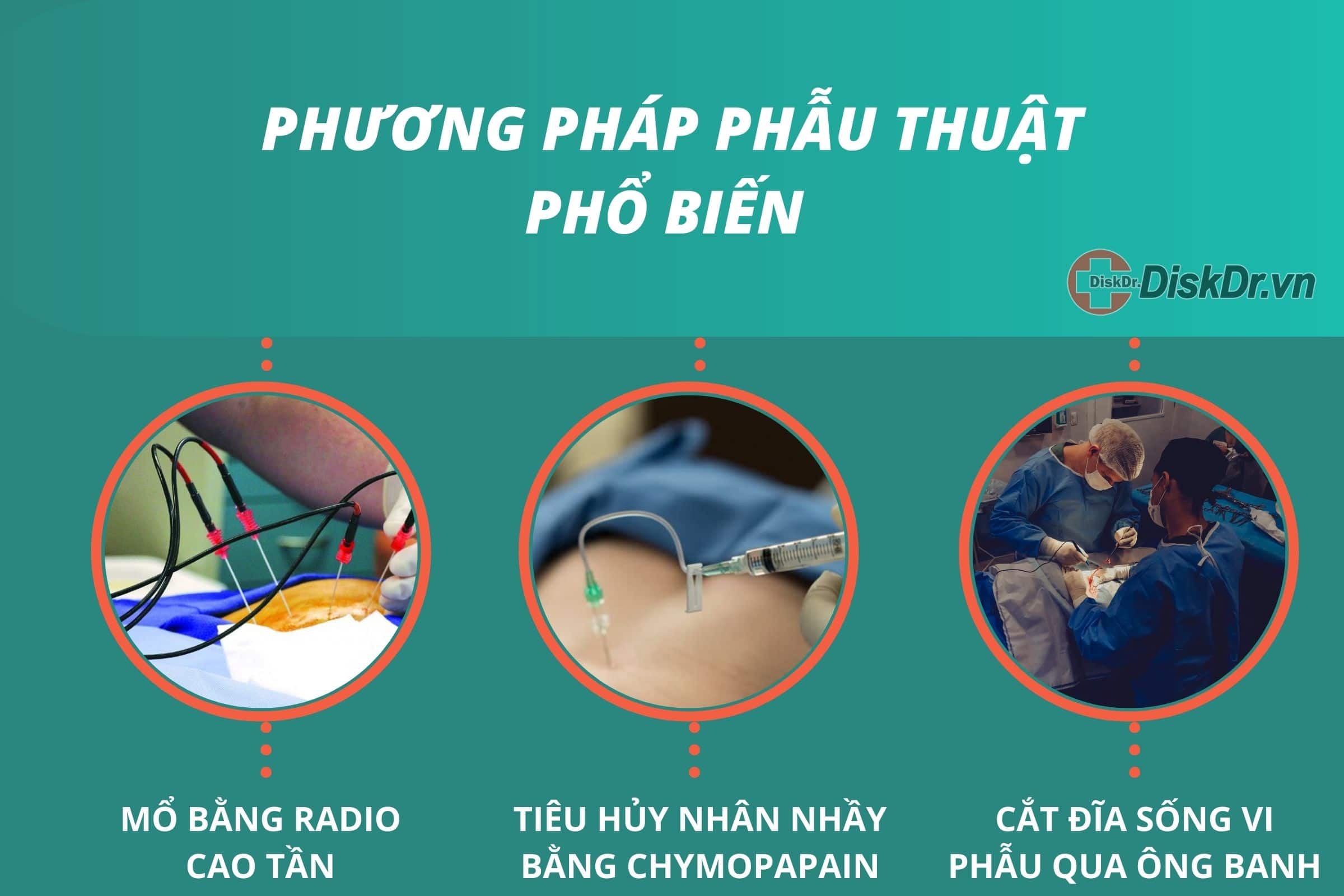 Mổ thoát vị đĩa đệm cột sống lưng