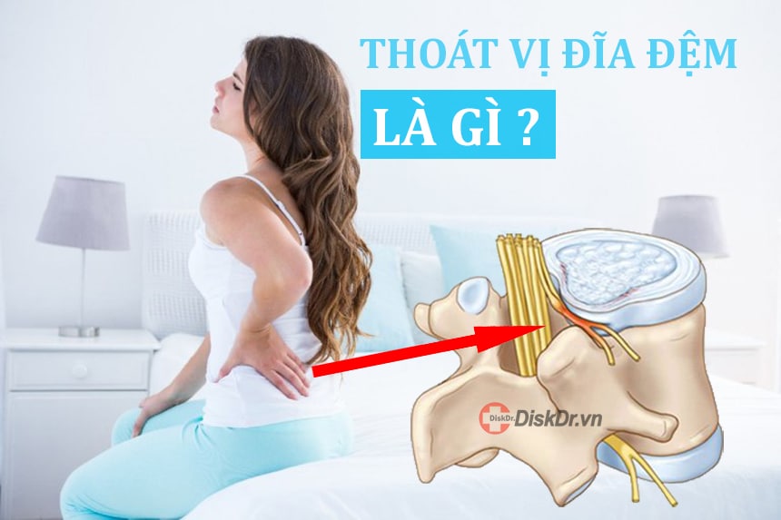 Thoát vị đĩa đệm là gì?