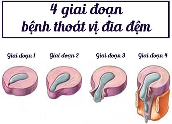 4 giai đoạn bệnh thoát vị đĩa đệm