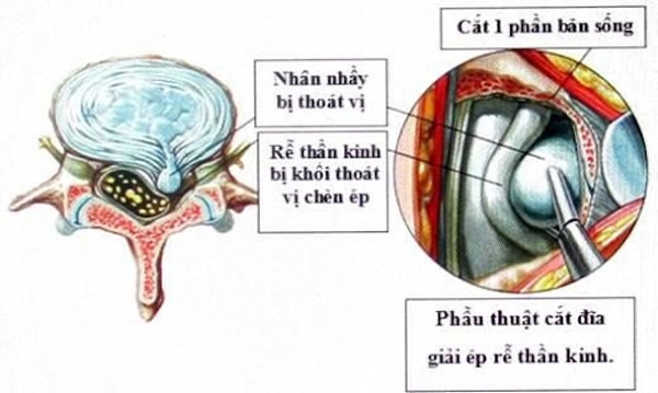 Phẫu thuật ít xâm lấn