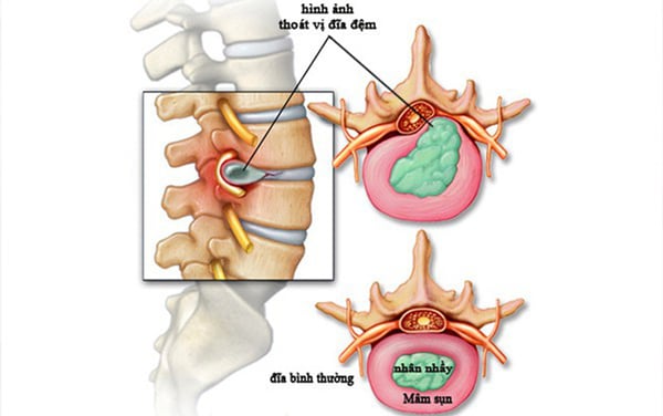 Thoát vị đĩa đệm