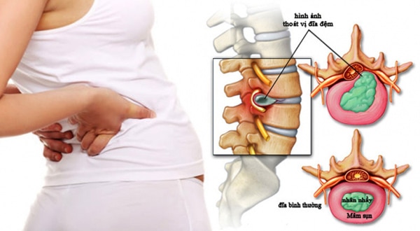 Những trường hợp được chỉ định sử dụng đai nịt thoát vị đĩa đệm