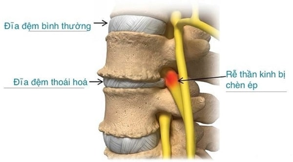 nguyên nhân gây đau lưng cấp tính