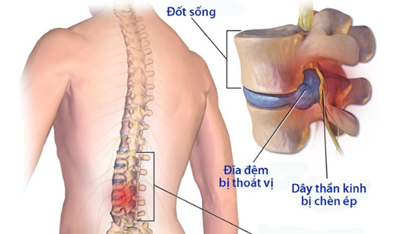 hình ảnh thoát vị đĩa đệm cột sống thắt lưng