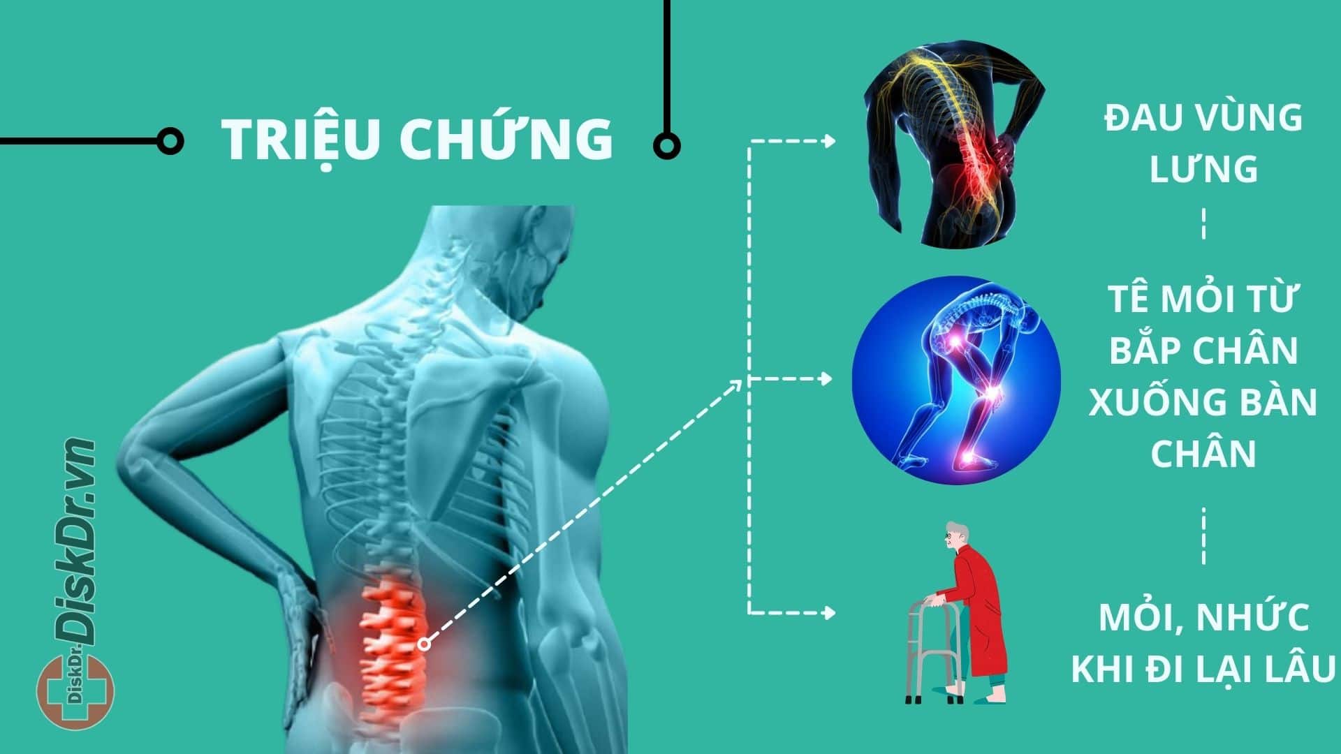 Thoát vị đĩa đệm L4 L5 có triệu chứng gì