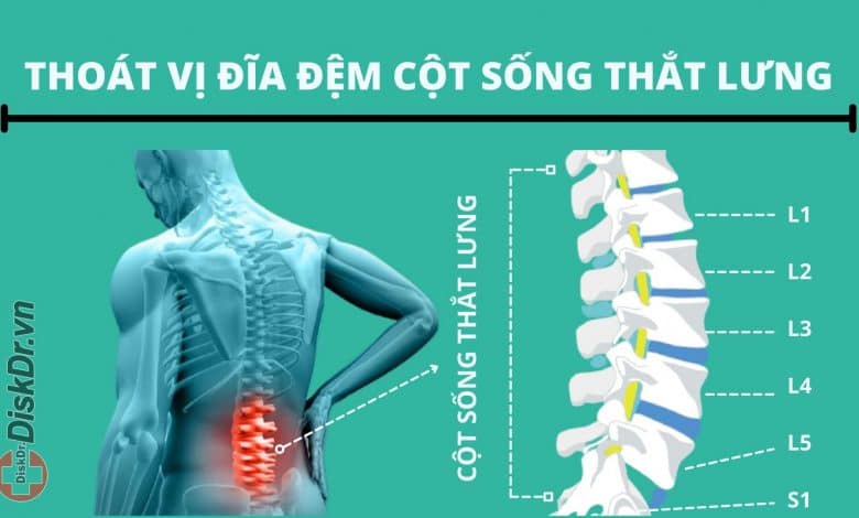 Thoát vị đĩa đệm cột sống thắt lưng là gì?