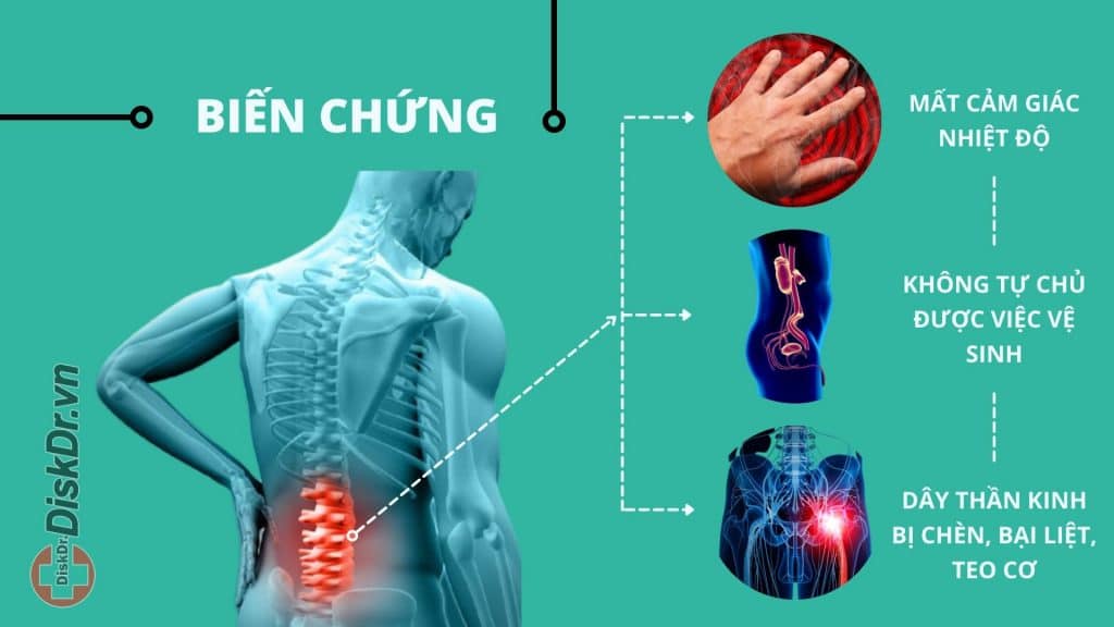 Thoát vị đĩa đệm L5 S1 có những biến chứng gì?