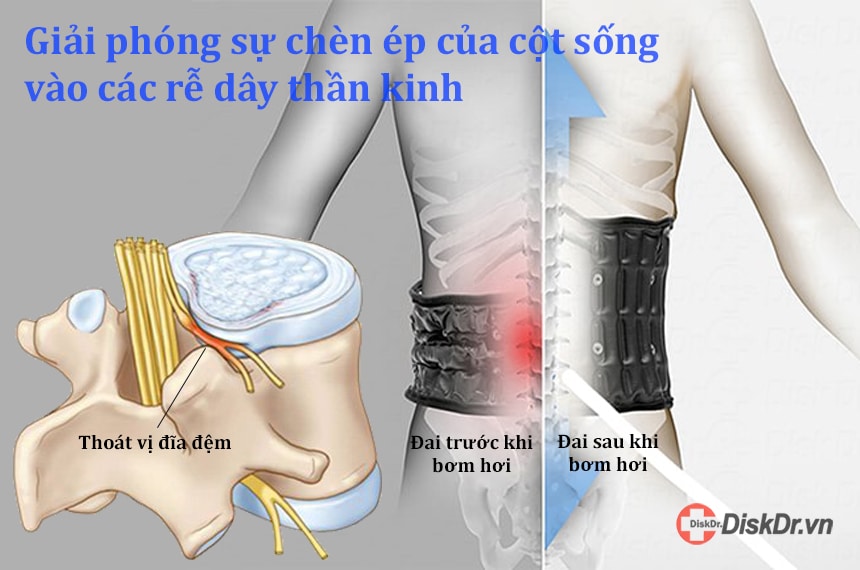 Đai giúp giải phóng sự chèn ép của cột sống vào các rễ dây thần kinh