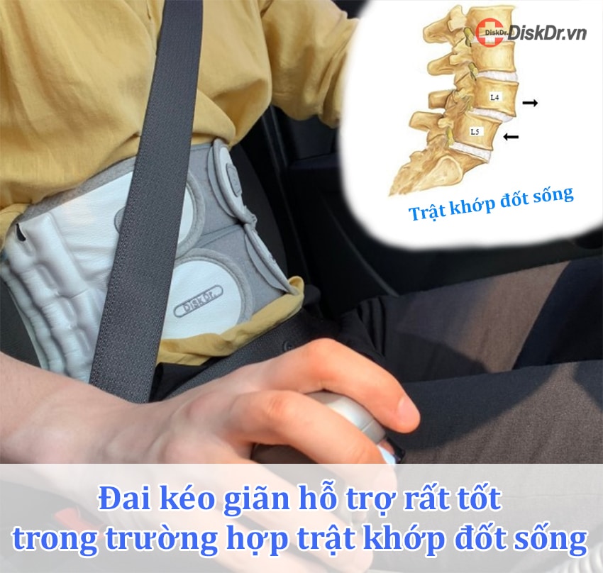 Đai kéo giãn hỗ trợ rất tốt trong trường hợp trật khớp đốt sống