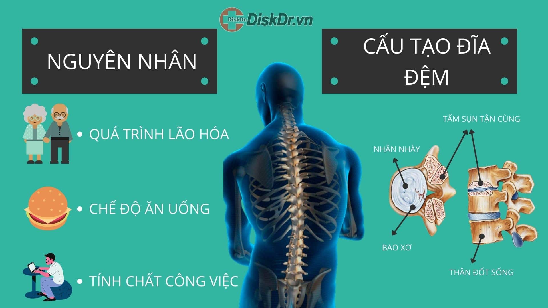 Nguyên nhân thoát vị đĩa đệm và cấu tạo đĩa đệm