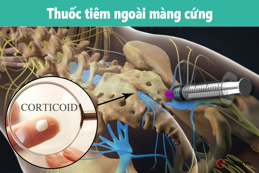 Thuốc tiêm ngoài màng cứng với người thoát vị đĩa đệm