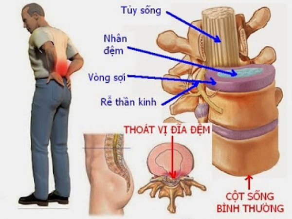 Triệu chứng bệnh thoát vị đĩa đệm