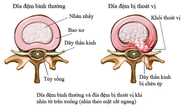 Cấu tạo của đĩa đệm