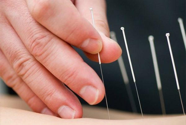 Điều trị thoát vị đĩa đệm bằng châm cứu