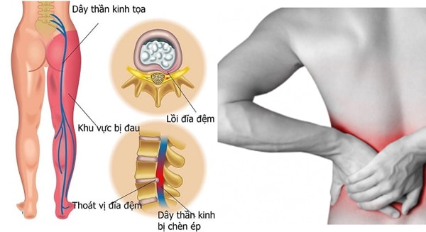 Công dụng khi chữa thoát vị đĩa đệm bằng phương pháp bấm huyệt