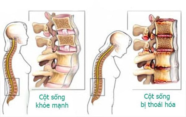 Cột sống thoái hóa