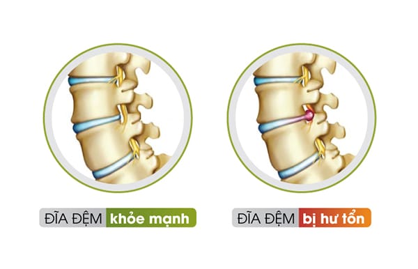 Đĩa đệm bị hư tổn sẽ gây chèn ép đến các rễ thần kinh xung quanh