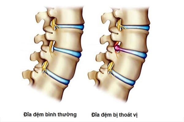 Đĩa đệm bị thoát vị