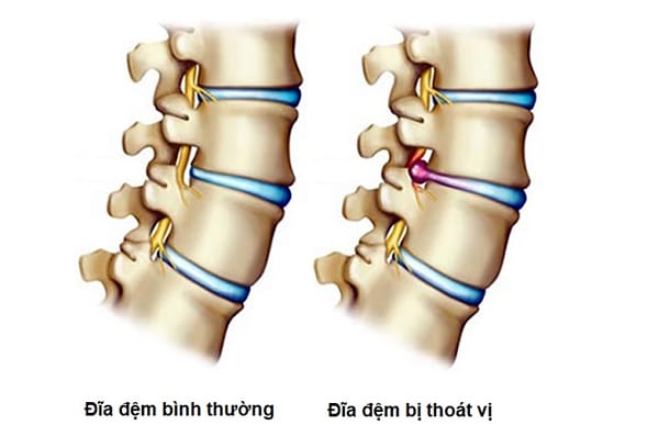 Thoát vị đĩa đệm gây chèn ép thần kinh