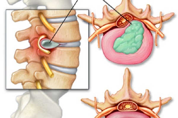 Đối tượng nên điều trị thoát vị đĩa đệm bằng phương pháp bấm huyệt