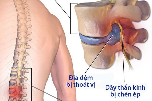 Đối tượng nên sử dụng đai kéo giãn cột sống