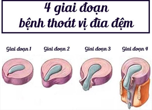 Giai đoạn của bệnh thoát vị đĩa đệm