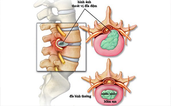 Hình ảnh thoát vị đĩa đệm