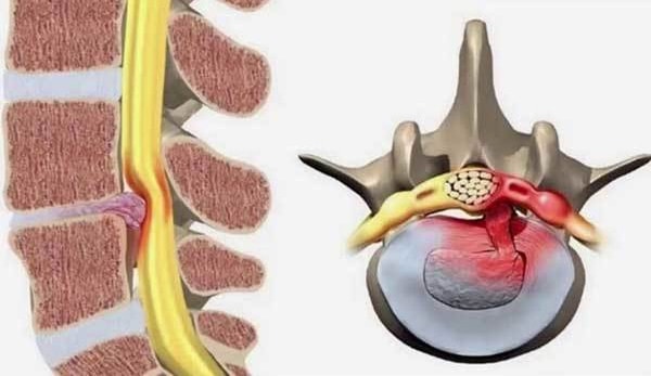 Thoát vị đĩa đệm không thể chữa khỏi hoàn toàn mà chỉ phục hồi tối đa nhất là 90%