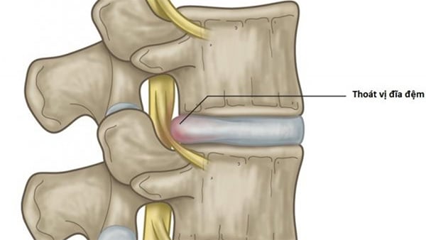 Đĩa đệm nằm giữa hai đột sống