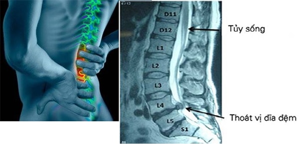 Chuẩn đoán hình ảnh giúp xác định vị trí, tình trạng phần vị thoát vị