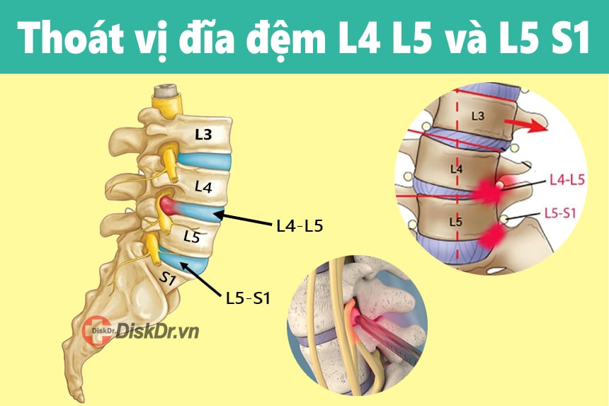 Thoát vị đĩa đệm L4 L5 và L5 S1