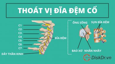 Thoát vị đĩa đệm cổ là gì?