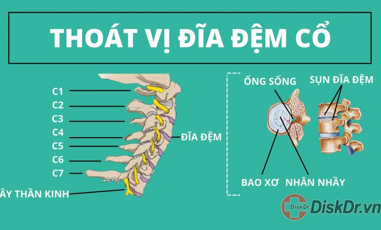 Thoát vị đĩa đệm cổ là gì?