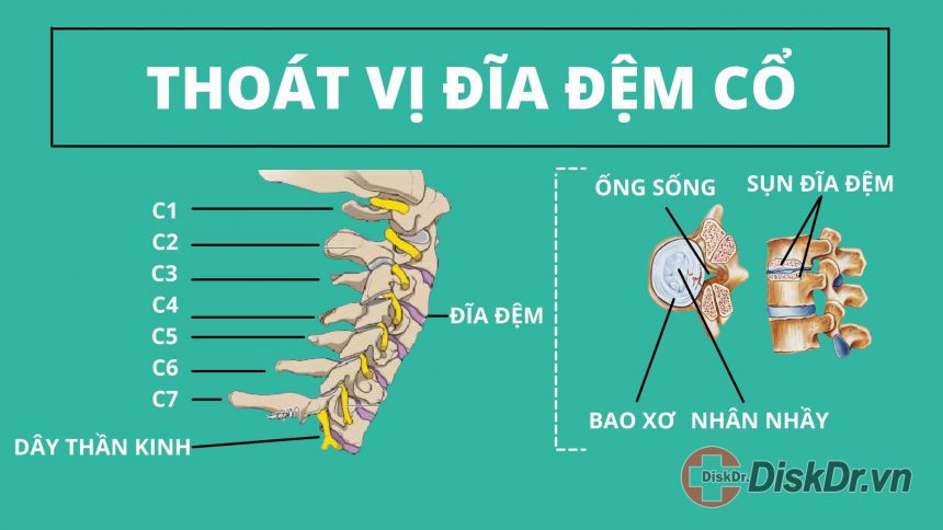 Thoát vị đĩa đệm cổ là gì?