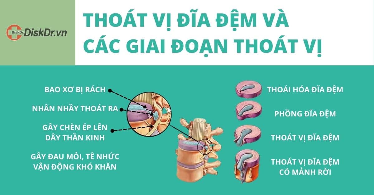 Các giai đoạn thoát vị đĩa đệm là gì?