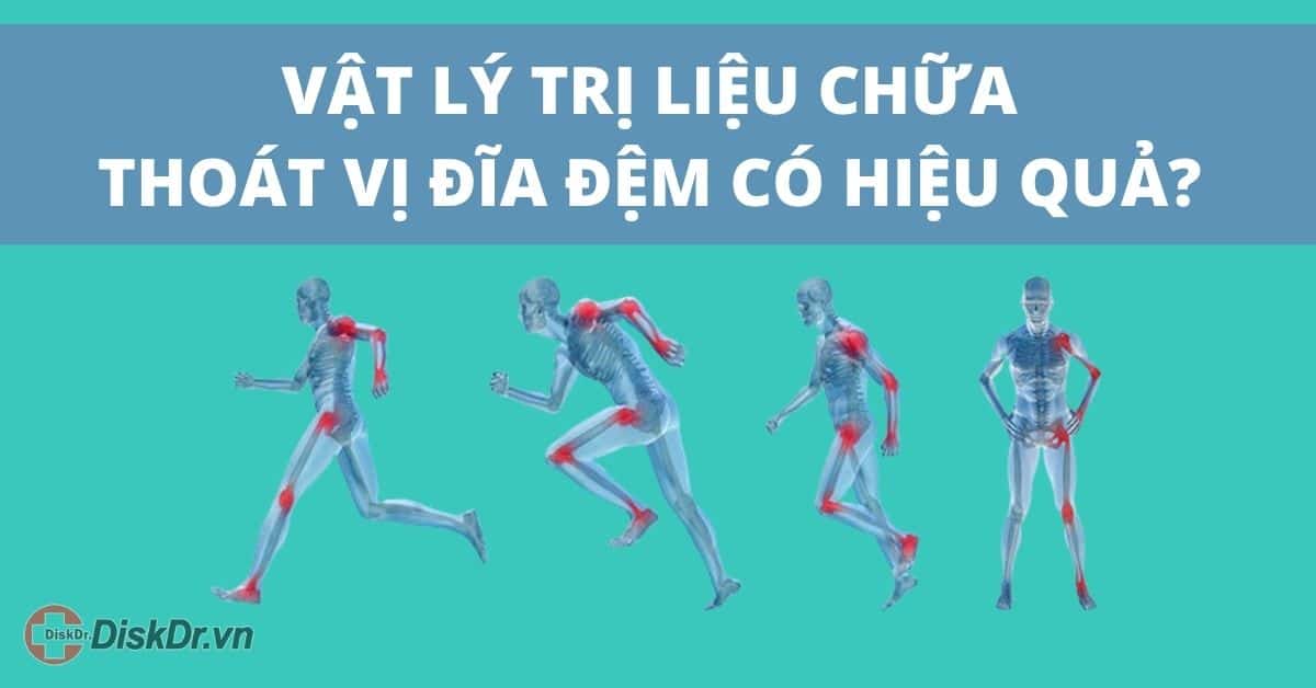 Vật lý trị liệu chữa thoát vị đĩa đệm