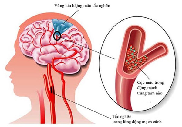 Biến chứng của bệnh thoát vị đĩa đệm