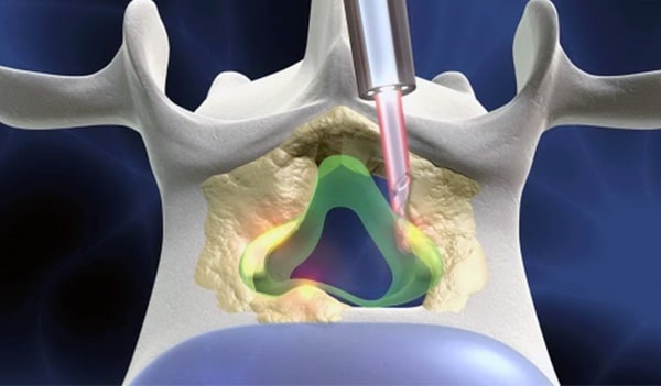 Điều trị thoát vị đĩa đệm cổ bằng tia laser