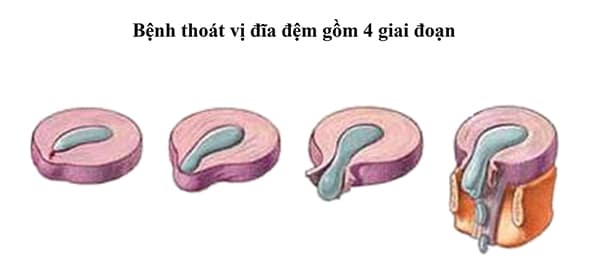 Các giai đoạn của bệnh thoát vị đĩa đệm