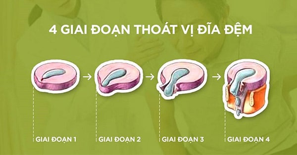 4 giai đoạn thoát vị đĩa đệm.