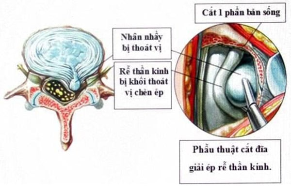 Phẫu thuật lấy khối thoát vị đĩa đệm