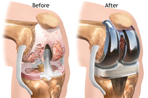 Phẫu thuật thay khớp gối toàn phần.