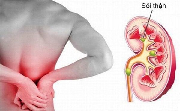 Sỏi thận, nhiễm trùng thận thường gây ra những cơn đau thắt vùng lưng trái.