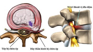 Thoát vị đĩa đệm cổ là gì