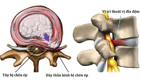 Thoát vị đĩa đệm cổ là gì